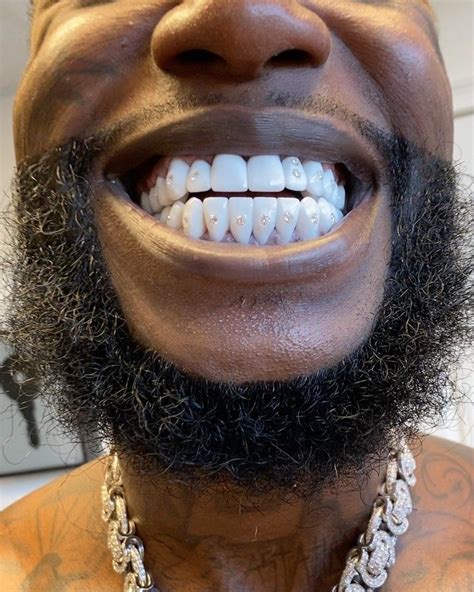 Gucci Mane teeth price